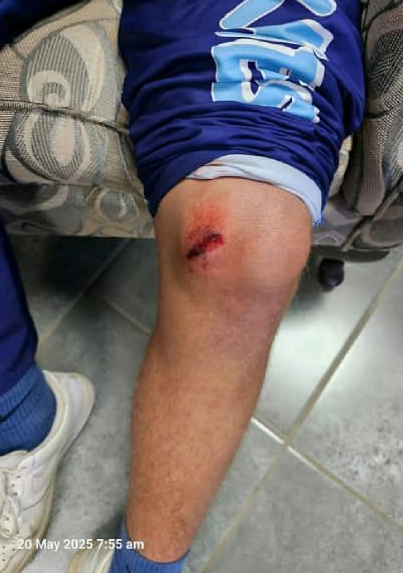 Student that has been bruised by the bullet of AK-47